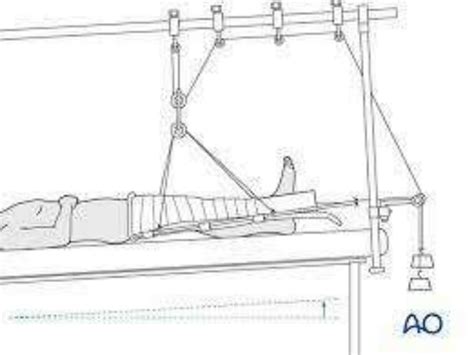 Image result for Different Types of Splints
