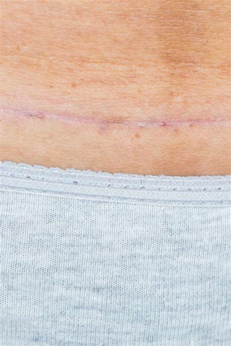 C-Section Wound 的图像结果