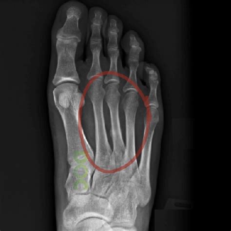 Xray Of Foot Stress Fracture