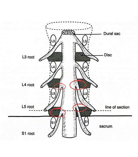 Disc Herniations: Where and Why?