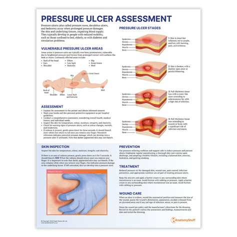 Pressure Ulcer Posterboard