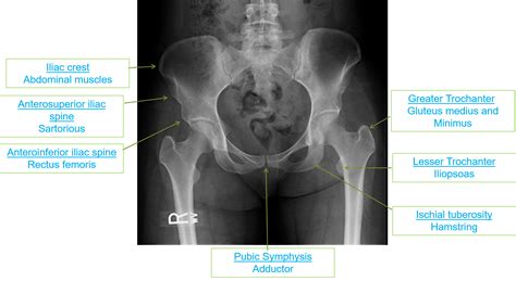 Avulsion Fracture Hip Iliac Crest