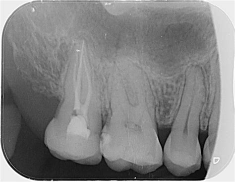 Periapical X Ray