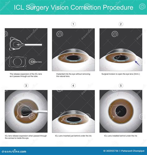 ICL Surgery Vision Correction Procedure. Stock Vector - Illustration of implantable, diagram ...