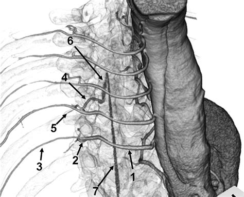 Artery Of Adamkiewicz Angiogram