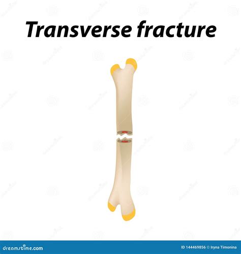 Transverse Fractures