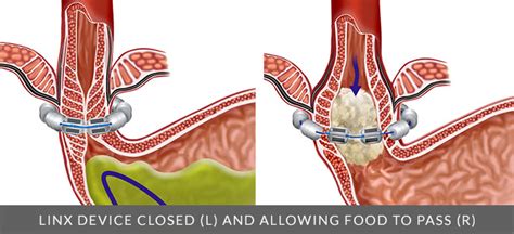 Image result for Linx Gerd Procedure