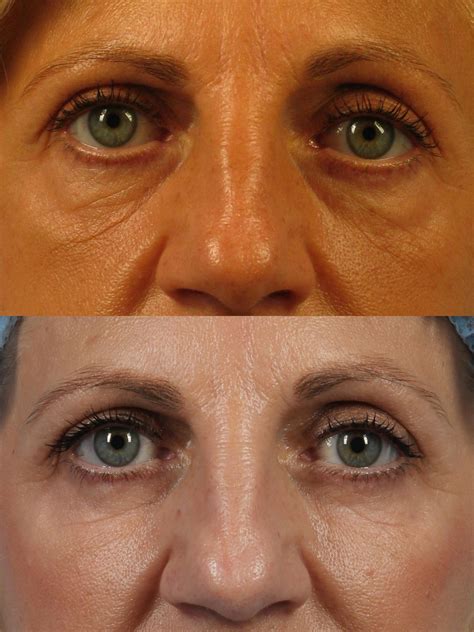 Facial Fat Grafting - Dr. Brett Kotlus