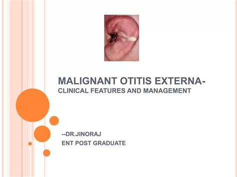 Malignant otitis externa clinical features and management | PPT