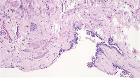 Epididymal Cyst Histology