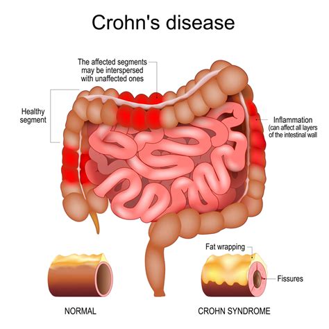 Síntomas de la Enfermedad de Crohn: qué es, causas y tratamiento de la enfermedad