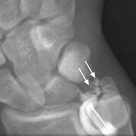 Peripheral Tear of the Triangular Fibrocartilage: Depiction with MR ...