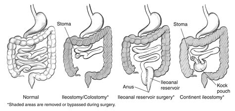 Normal bowel and three types of bowel diversion surgeries, including ...