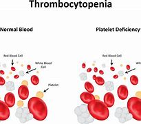 Image result for thrombocytopenic