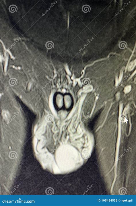 Pelvic Mri Diagnostic Varicocele Pathology Man Stock Photo - Image of ...