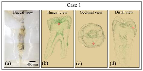 Molecular Fingerprint Imaging to Identify Dental Caries Using Raman ...