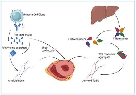 Diagnosing AL and ATTR Amyloid Cardiomyopathy: A Multidisciplinary Approach