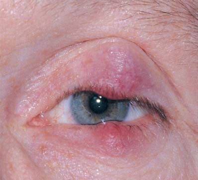 Bildergebnis für blepharitis symptome