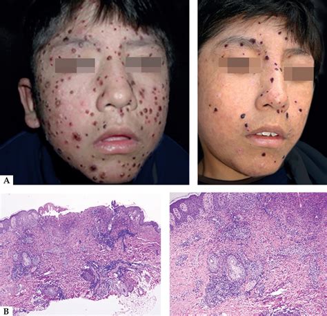 Epstein Barr Thyroid Connection – DVVE