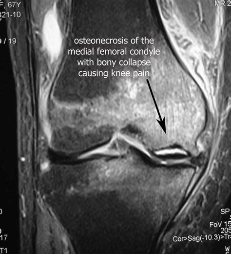 Partial Knee Replacement for Painful Knee | HC Chang Orthopaedic ...