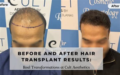 Hair Transplant Before After Results | Cult Aesthetics