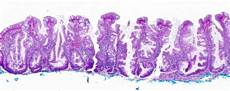 Pathology Outlines - Sessile serrated adenoma