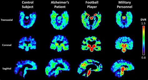 CTE Brain 的图像结果