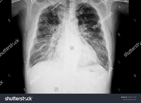 Initial Chest Xray Revealed Interstitial Pulmonary Edema