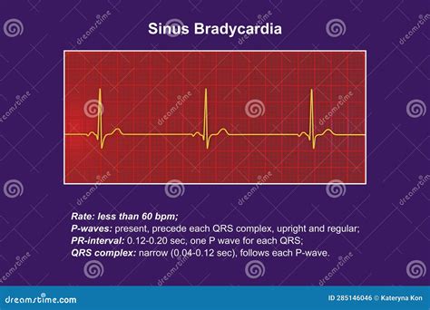 Electrocardiogram Displaying Sinus Bradycardia, 3D Illustration Stock ...