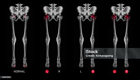 Image result for Normal Leg Alignment