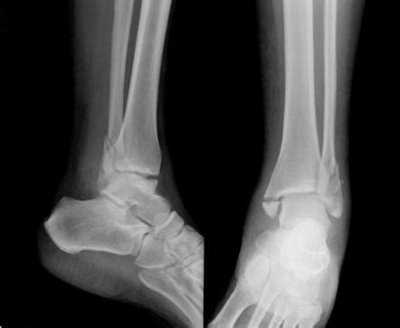 Trimalleolar fracture | Radiology Reference Article | Radiopaedia.org