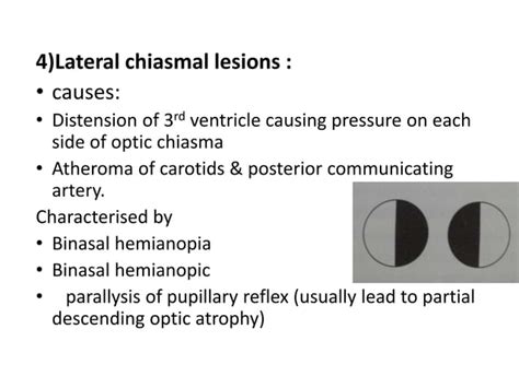 Image result for Visual Pathway Defects