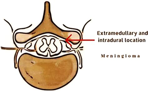 Frontiers | Spinal meningiomas, from biology to management - A literature review