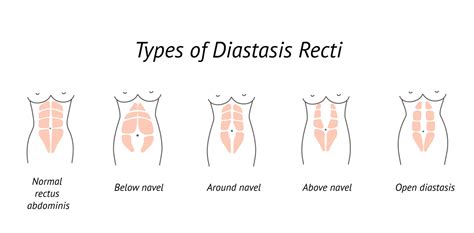 Postpartum Wrap Support Belt - Diastasis Recti