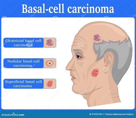 Illustration Of Basal Cell Carcinoma | CartoonDealer.com #97522798