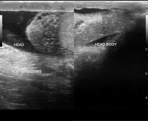 Image result for Transillumination Test Testis