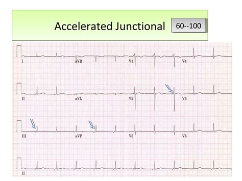 ECG Atrial and Junctional rhythms Dr Sarfaraz | PPT