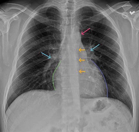 Normal Chest X Rays Pictures