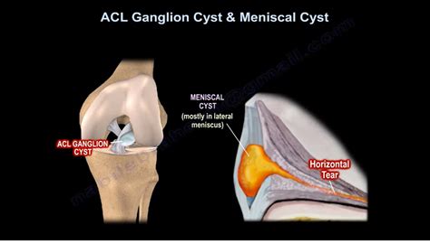 Baker's Cyst Ganglion at Lucinda Mccathie blog