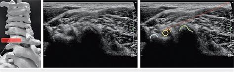 Image result for Selective Nerve Root Block C6