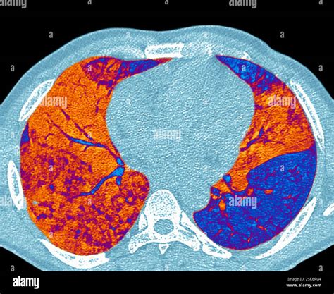 Pneumonia Ct Scan