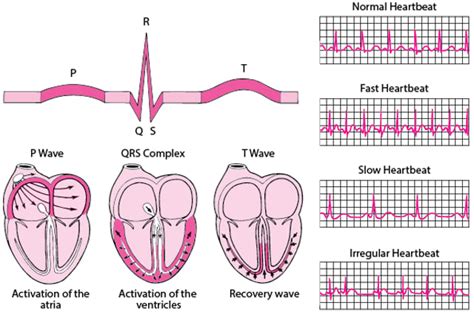 Torsades de Pointes Ventricular Tachycardia - Torsades de Pointes ...