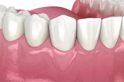 Gum Grafting | Arkansas Periodontal and Implant Associates
