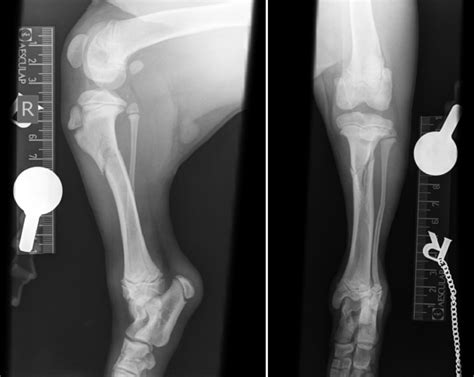 Tibia And Fibula X Ray X Ray Image Of Tibia And Fibula Fracture. AP