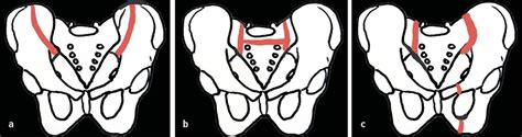 Osteoporoseassoziierte Fragilitätsfrakturen des Beckenrings ...