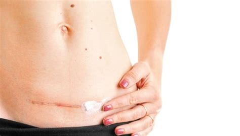 C-Section Wound 的图像结果