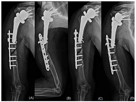 The Treatment of Periprosthetic Fracture Revision of the Humerus with ...