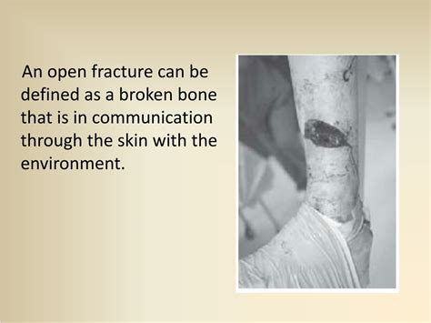 PPT - OPEN (COMPOUND) FRACTURES PowerPoint Presentation, free download ...