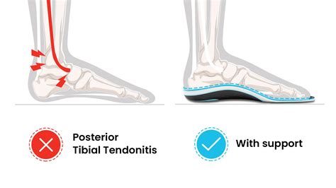Arch Support Insoles for Posterior Tibial Tendonitis and PTTD – PCSsole