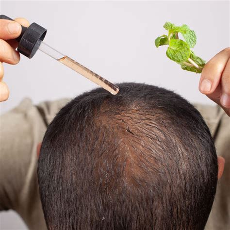 Male Pattern Baldness: Causes, Symptoms, and Treatments